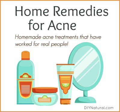 Home Remedies for Acne Homemade Treatment