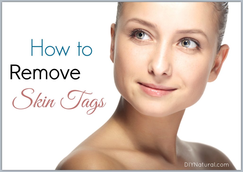 home remedy to remove skin tags on eyelids