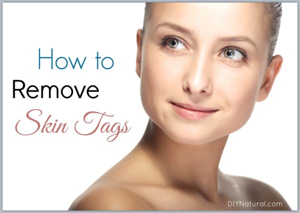 How-To-Remove-Skin-Tags-600x425.jpg