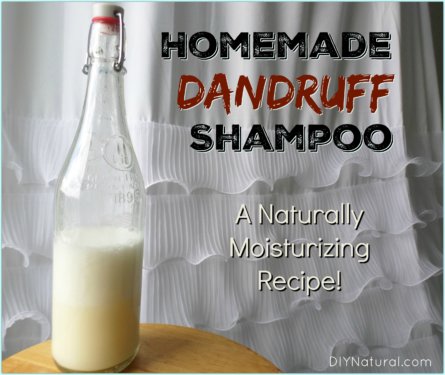 Home Remedies for Dandruff: A Dandruff