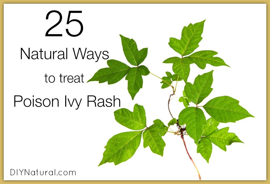 how to treat poison ivy
