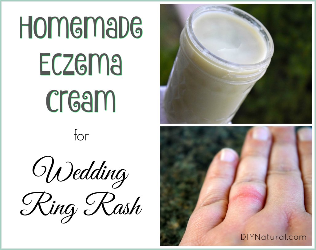 Homemade Eczema Cream Relief For Wedding Ring Rash And More